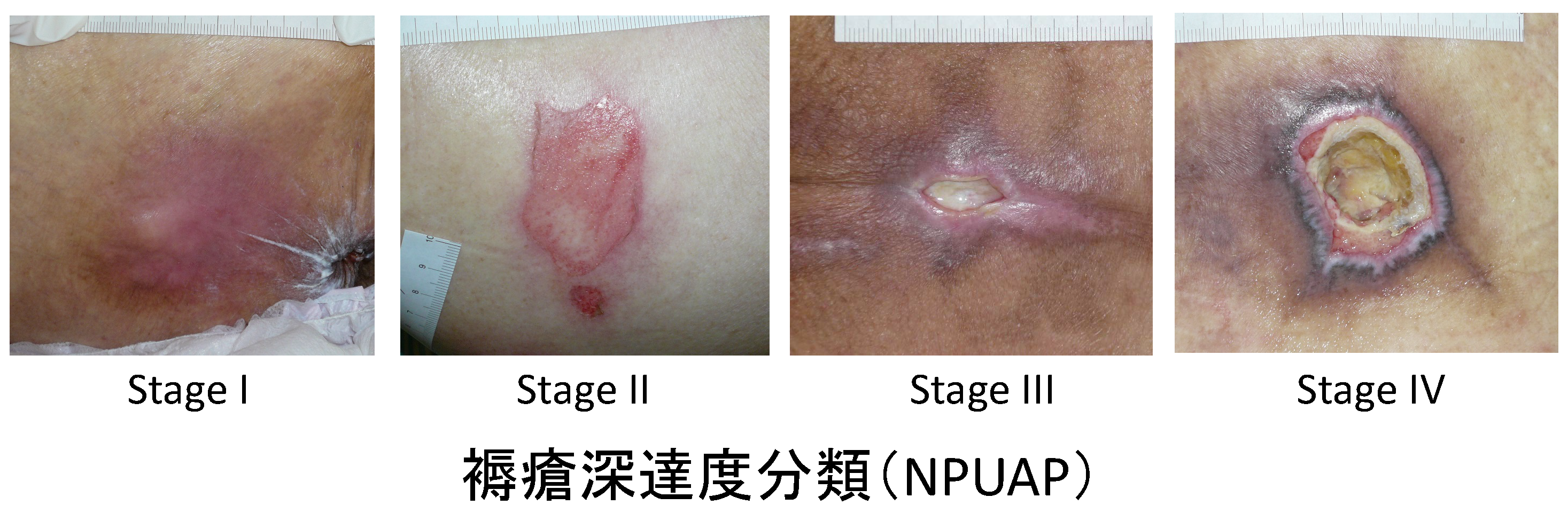 段階 画像 じょくそう 褥瘡の分類